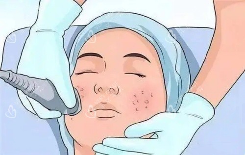 激光面部祛痣示意图 激光面部祛痣示意图