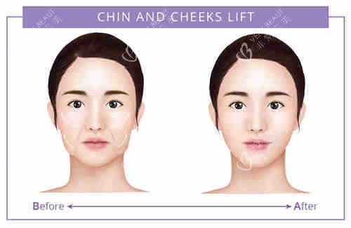 面部提升对比图