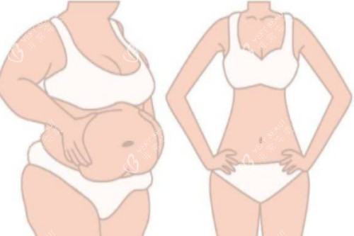 吸脂塑形对比图 吸脂塑形对比图