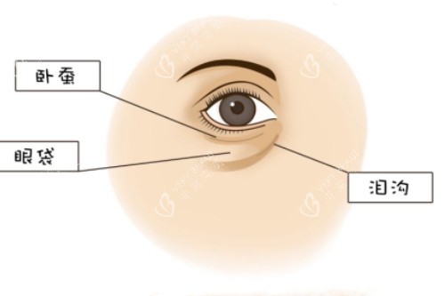 卧蚕、眼袋、泪沟展示图 卧蚕、眼袋、泪沟展示图