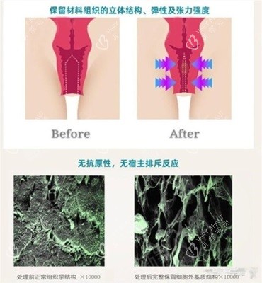 3d生物束带紧缩术前后对比漫画 3d生物束带紧缩术前后对比漫画