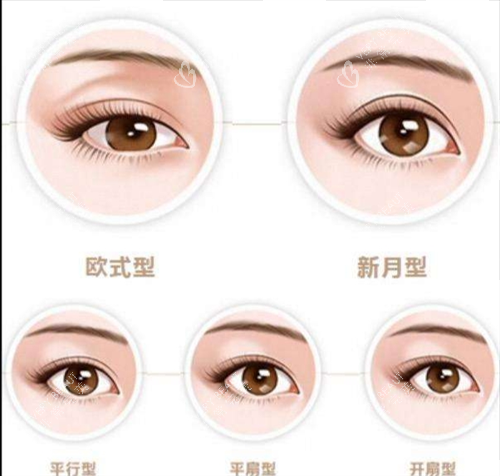 双眼皮类型图示 双眼皮类型图示