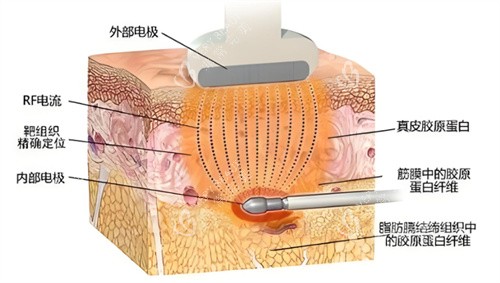 激光溶脂原理图 激光溶脂原理图