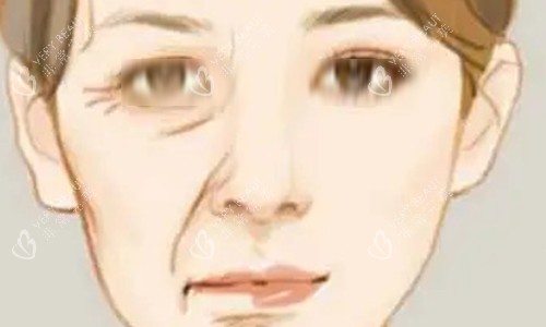 拉皮手术的对比动画图