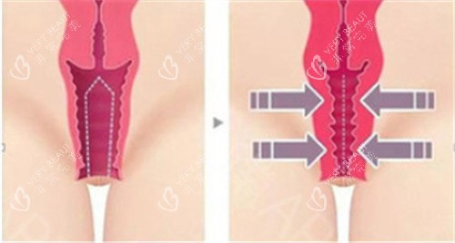 私密紧缩手术前后对比差异