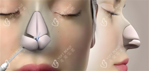 鼻综合鼻骨动画