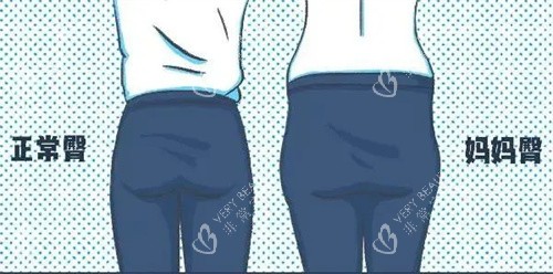 正常臀部和妈妈臀对比动画图