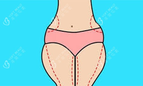 大腿吸脂手术设计方案示意图 大腿吸脂手术设计方案示意图