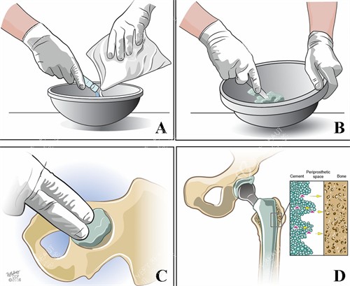 骨水泥修复骨头缺失过程 骨水泥修复骨头缺失过程