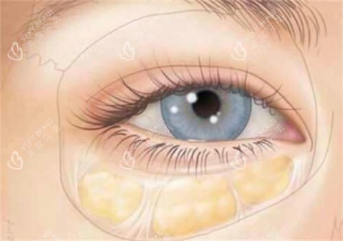 眼袋所在位置 眼袋所在位置