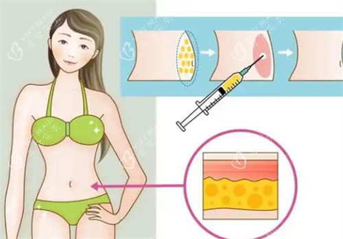 吸脂手术腰部