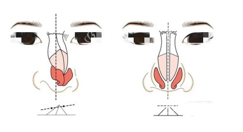 假体鼻子歪斜漫画示意图