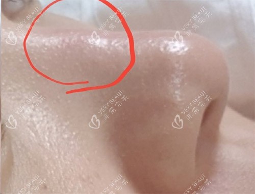 隆鼻炎症透光图片 隆鼻炎症透光图片