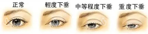 上睑下垂分级.webp 上睑下垂分级.webp