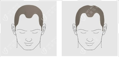 发际线后移类型 发际线后移类型