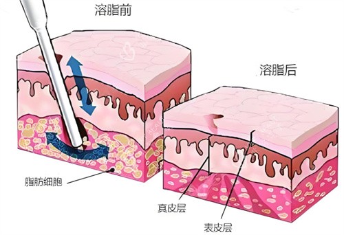 射频溶脂术皮肤层 射频溶脂术皮肤层