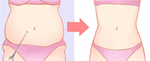 肚子吸脂前后对比 肚子吸脂前后对比