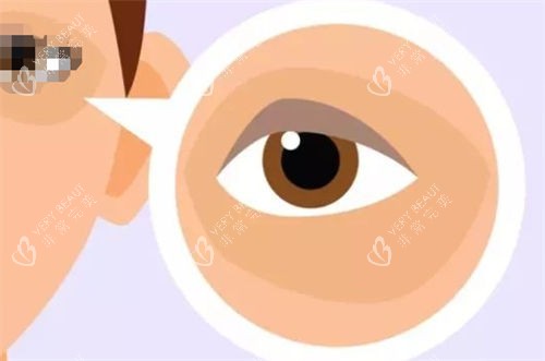 黑眼圈眼袋示意图 黑眼圈眼袋示意图