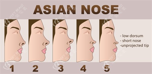 鼻头朝天矫正过程图