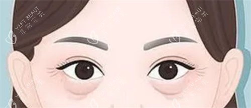 眼袋松弛和泪沟细纹展示图