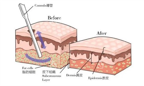 吸脂手术 吸脂手术