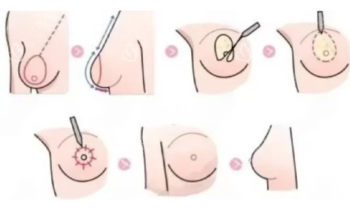 双环法缩胸展示 双环法缩胸展示