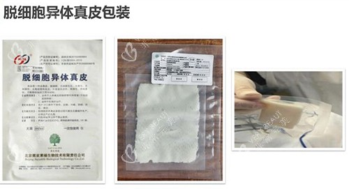 3d生物束带紧缩术材料包装示意图 3d生物束带紧缩术材料包装示意图