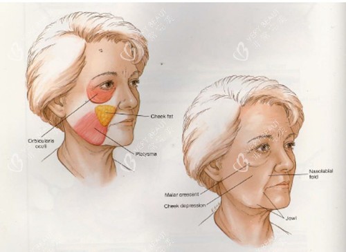 面部线提升对比 面部线提升对比
