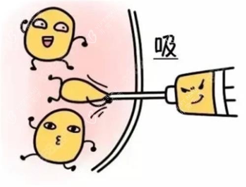 吸脂手术动画 吸脂手术动画