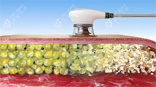 超声波溶脂过程演示图 超声波溶脂过程演示图