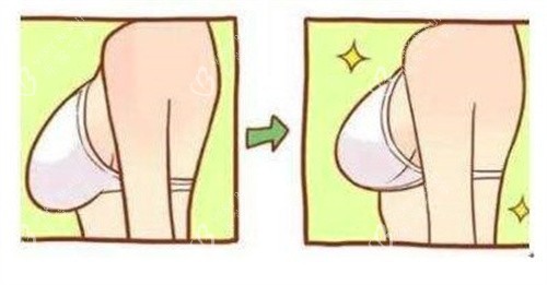 隆胸手术对比