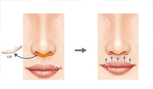 人中缩短手术切除部位 人中缩短手术切除部位