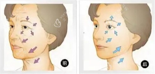 面部抗衰对比图