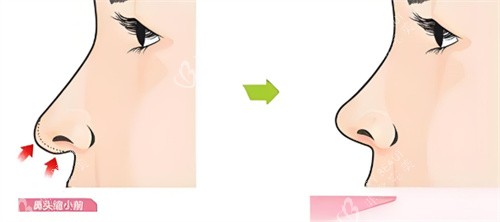 鼻头缩小前后对比