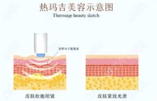 热玛吉美容示意图 热玛吉美容示意图