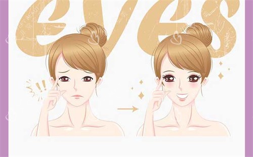 双眼皮手术前后对比图 双眼皮手术前后对比图