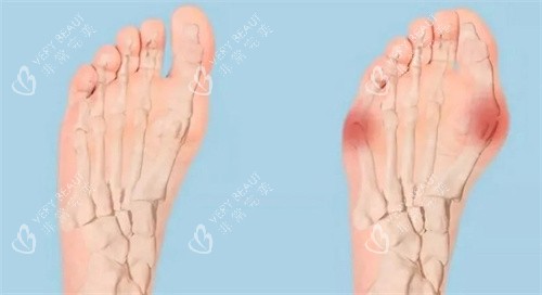 拇外翻对比