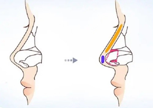 鼻小柱延长结构示意图