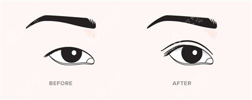 双眼皮手术前后对比 双眼皮手术前后对比