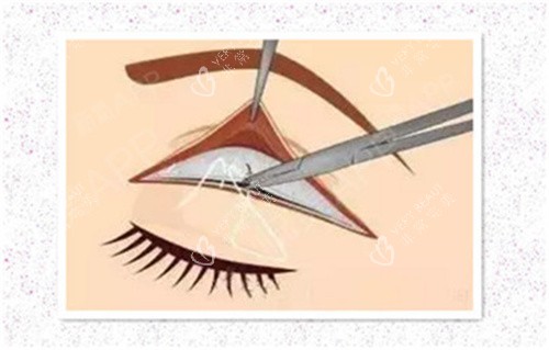 双眼皮肉条修复术 双眼皮肉条修复术