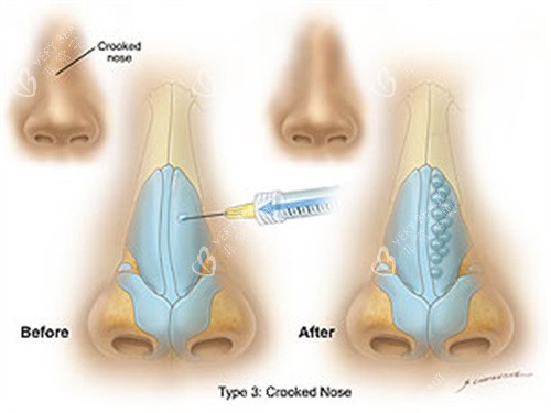 玻尿酸注射隆鼻前后对比 玻尿酸注射隆鼻前后对比