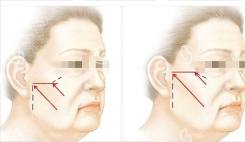中上面部拉皮提拉方向画线图