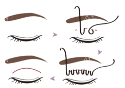 埋线双眼皮过程图示 埋线双眼皮过程图示