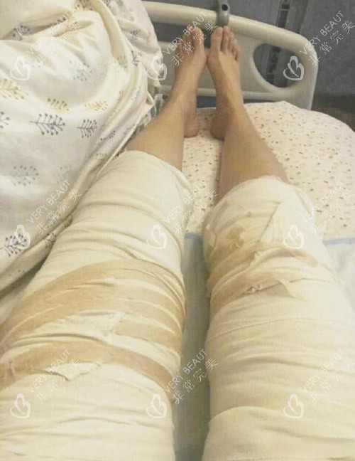 大腿吸脂照片 大腿吸脂照片