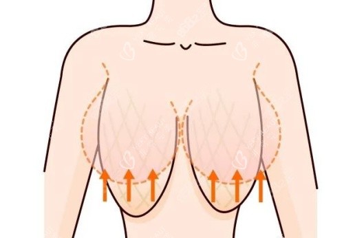 缩胸形态示意图 缩胸形态示意图