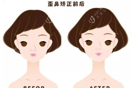 假体鼻子歪斜矫正前后示意图
