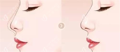 液态隆鼻后的成效 液态隆鼻后的成效