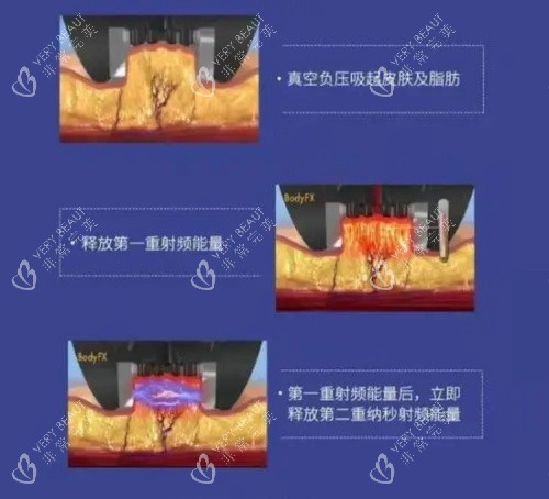 钻石超塑整形的优势示意图 钻石超塑整形的优势示意图