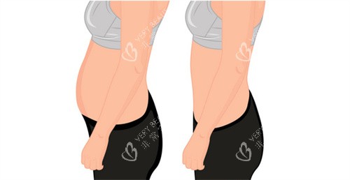 腹部吸脂对比 腹部吸脂对比