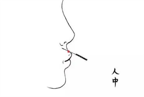 人中加深玻尿酸 人中加深玻尿酸